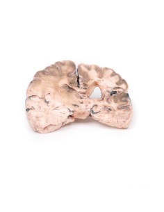 Left cerebral infarction - Erler Zimmer 3D anatomy Series... 2