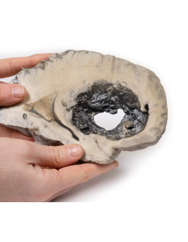 Emorragia cerebrale - Erler Zimmer 3D anatomy...