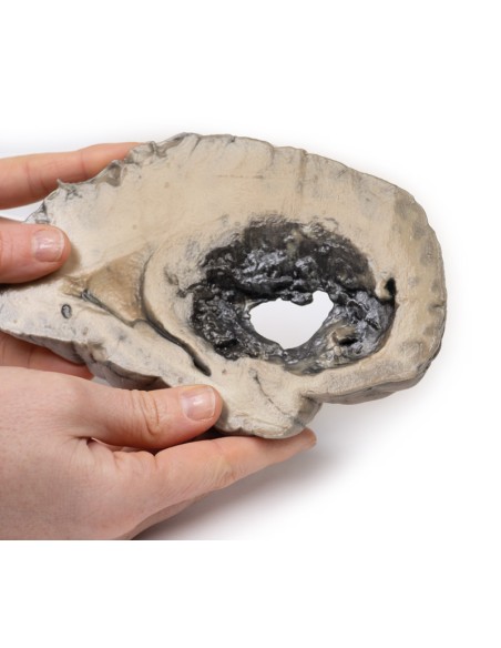 Hirnblutung - Erler Zimmer 3D-Anatomie Serie MP2002