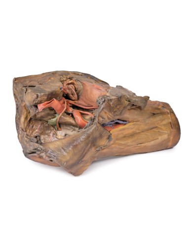 Dissection de l'hémipel et de la cuisse...