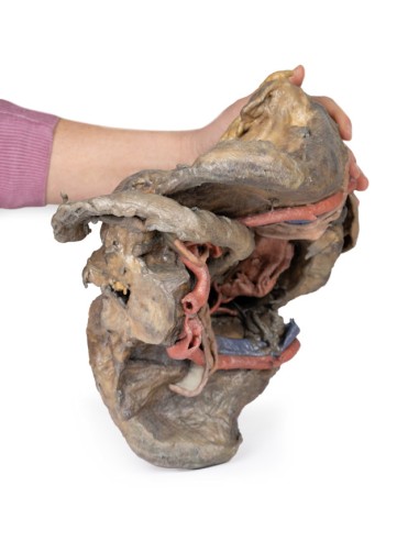 Disección profunda de la pelvis femenina -...