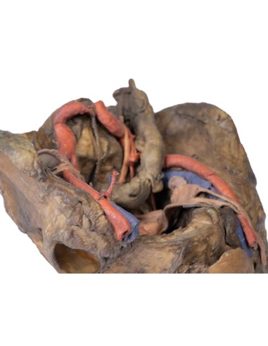 Disección profunda de la pelvis femenina -...