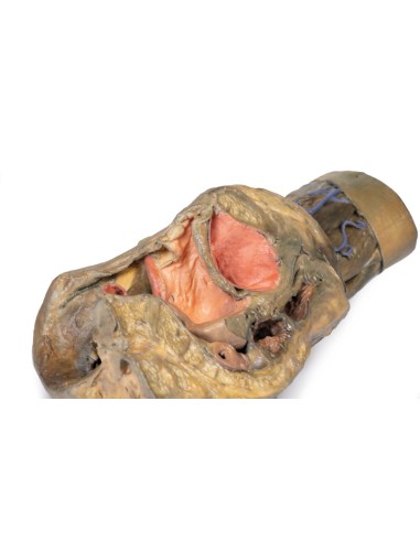 Dissection de l'hémipel et de la cuisse...