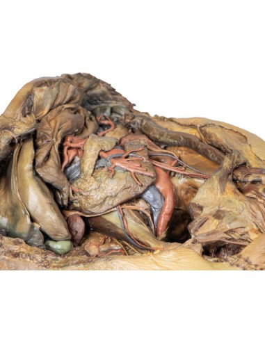 Dissection of the abdomen with inguinal hernia...