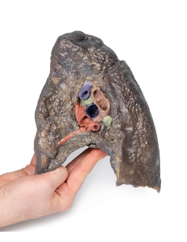 Dissection of the hilum of the right lung -...