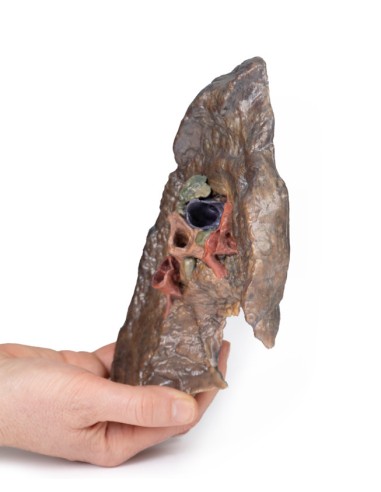 Ilo of the left lung - Erler Zimmer 3D anatomy...