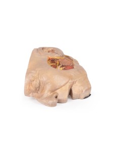 Dissection de la glande parotide et du nerf facial -... 2